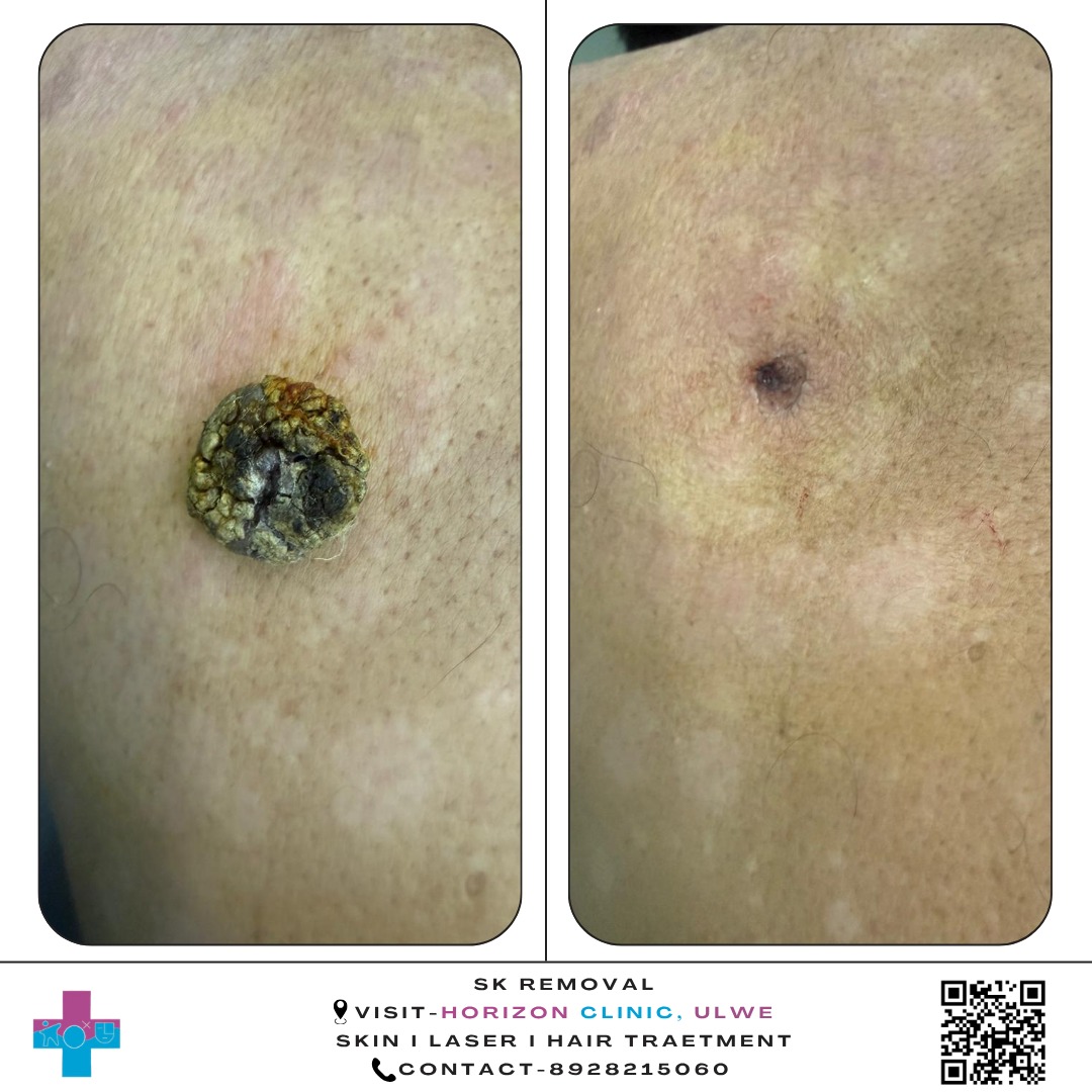 Seborrheic Keratosis Removal